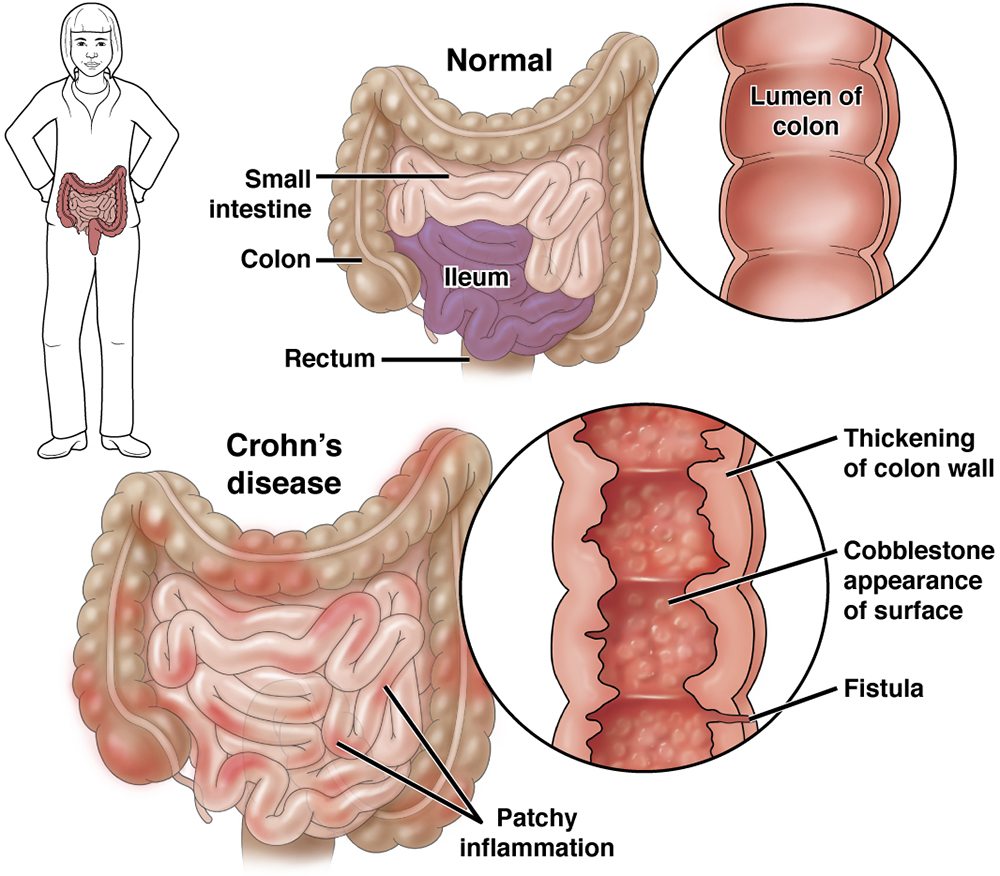 Crohns Disease Aga Gi Patient Center