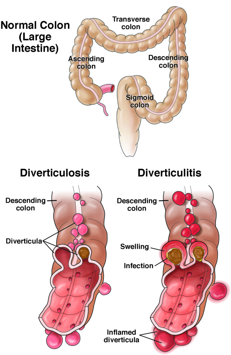 Diverticulitis Aga Gi Patient Center 3270