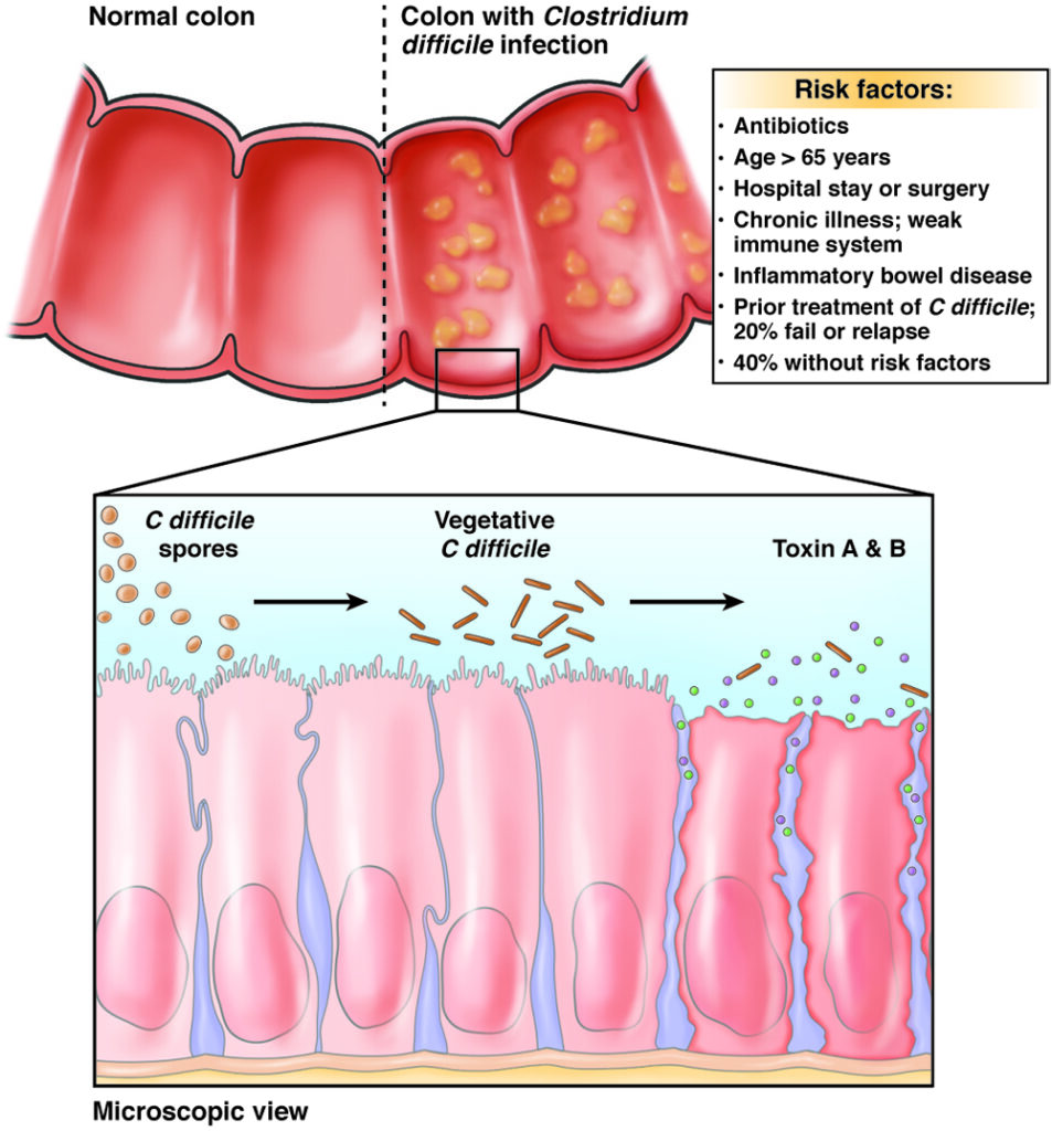 Image of a colon with C. diff infection and the microscopic view of C. diff.