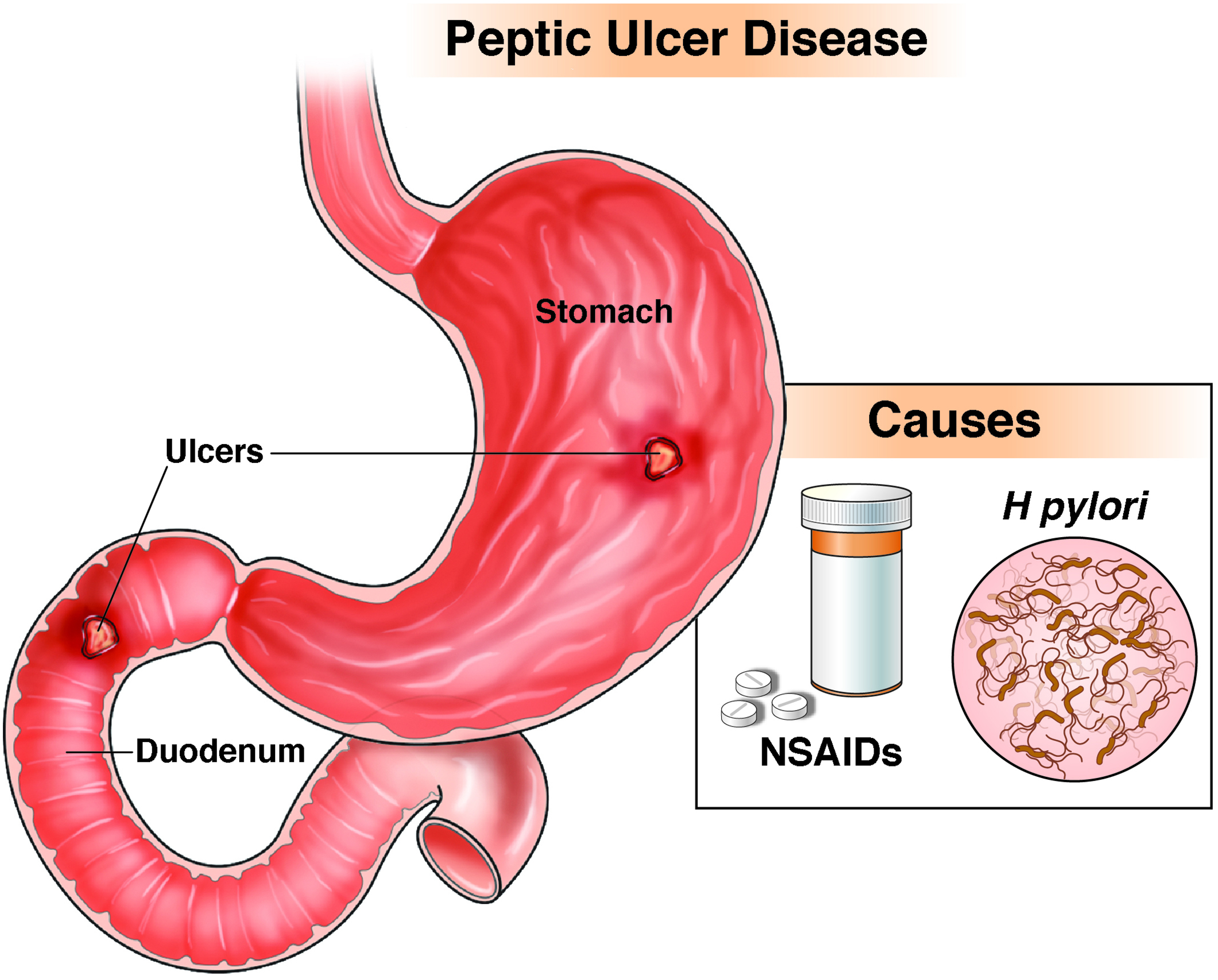 what-are-the-symptoms-of-stomach-ulcer-infographic